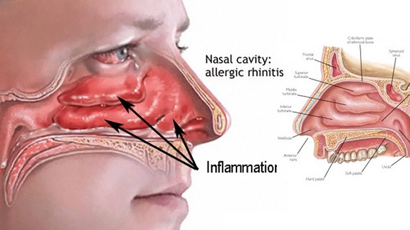 The best Natural Remedies For Nasal Congestion 