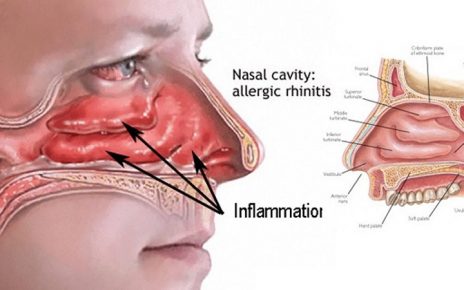 natural remedies for nasal congestion
