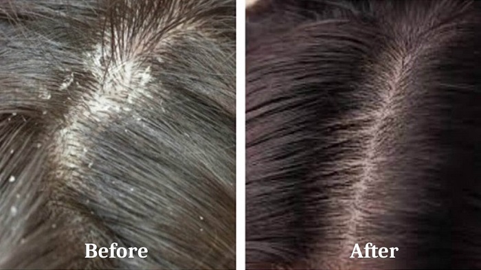 How can I get rid of dandruff permanently
