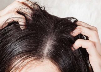 How can I get rid of dandruff permanently